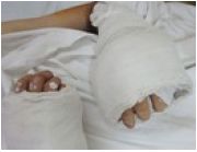 Nối thành công hai bàn tay đứt lìa