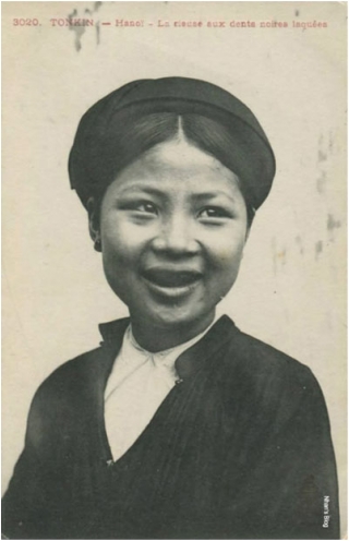 Bản sắc răng đen bị