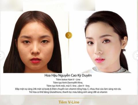 Thẩm mỹ viện chứng minh Hoa hậu Kỳ Duyên nói dối - 2 Thẩm mỹ viện chứng minh Hoa hậu Kỳ Duyên nói dối - 2