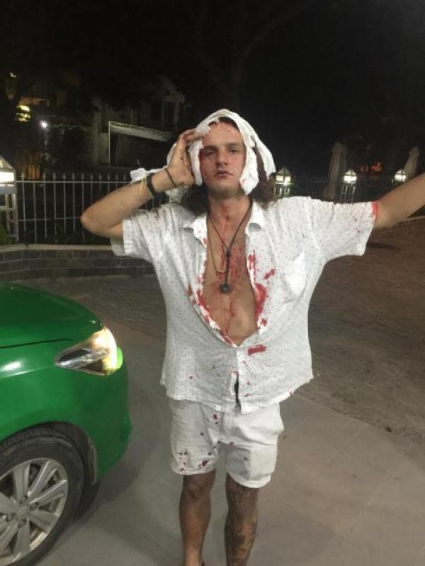 Khách Tây bị đánh vỡ đầu ở Hội An, khâu 11 mũi - 1 Khách Tây bị đánh vỡ đầu ở Hội An, khâu 11 mũi - 1