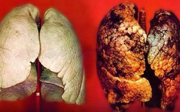 Căn bệnh ung thư gây tử vong nhanh nhưng 90% có thể chữa khỏi nếu nhận biết dấu hiệu này - 0 Căn bệnh ung thư gây tử vong nhanh nhưng 90% có thể chữa khỏi nếu nhận biết dấu hiệu này - 0