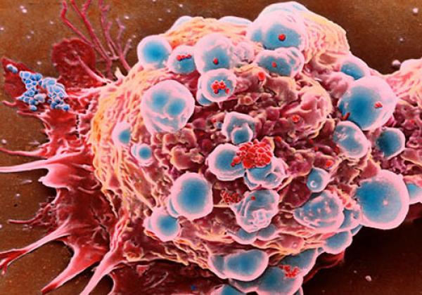 Căn bệnh ung thư rất hay gặp ở phụ nữ, làm thế nào để ngăn chặn? - 1 Căn bệnh ung thư rất hay gặp ở phụ nữ, làm thế nào để ngăn chặn? - 1