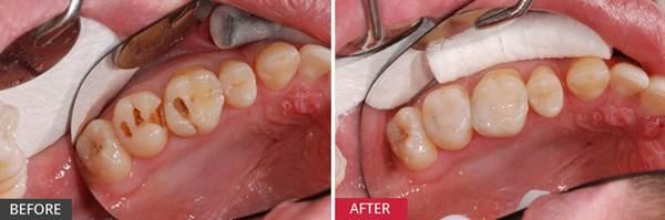 1 nhúm muối – 3 cách lấy sạch cao răng ố vàng, trị dứt điểm sâu răng đau nhức, trả lại hơi thở thơm mát tức thì - 3 1 nhúm muối – 3 cách lấy sạch cao răng ố vàng, trị dứt điểm sâu răng đau nhức, trả lại hơi thở thơm mát tức thì - 3