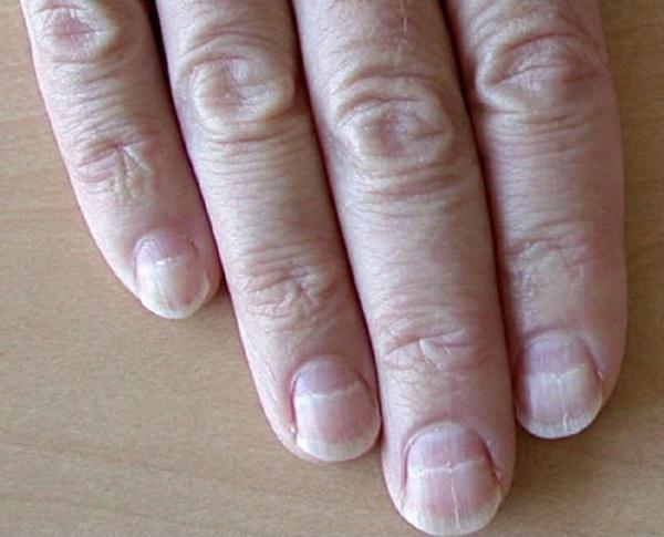 Hãy đến bác sĩ ngay nếu phát hiện móng tay có 3 dấu hiệu lạ này - 1 Hãy đến bác sĩ ngay nếu phát hiện móng tay có 3 dấu hiệu lạ này - 1
