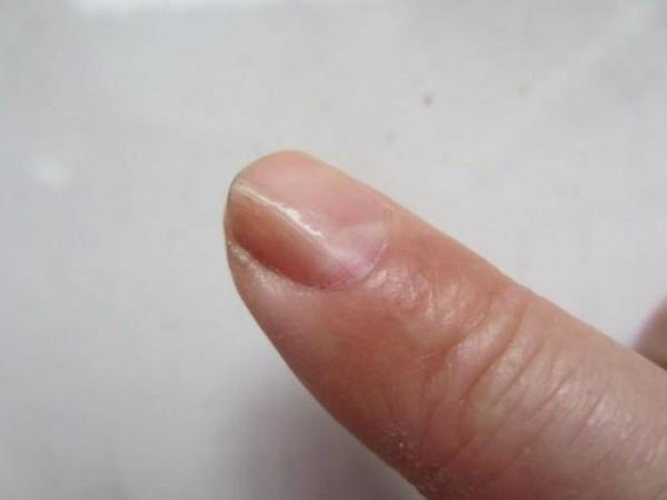 Hãy đến bác sĩ ngay nếu phát hiện móng tay có 3 dấu hiệu lạ này - 0 Hãy đến bác sĩ ngay nếu phát hiện móng tay có 3 dấu hiệu lạ này - 0