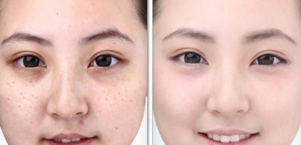 Học người xưa 6 bí quyết trị tàn nhang từ thiên nhiên ngay tại nhà - 0 Học người xưa 6 bí quyết trị tàn nhang từ thiên nhiên ngay tại nhà - 0