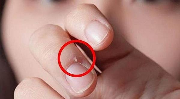 Ngón tay dễ bị hoại tử vì thói quen cắn xước măng rô - 0 Ngón tay dễ bị hoại tử vì thói quen cắn xước măng rô - 0