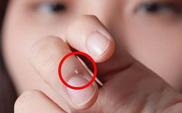 Ngón tay dễ bị hoại tử vì thói quen cắn xước măng rô - 2 Ngón tay dễ bị hoại tử vì thói quen cắn xước măng rô - 2