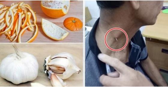 Cách chữa hóc xương cá vô cùng đơn giản lại rất hiệu quả mà ai cũng nên biết