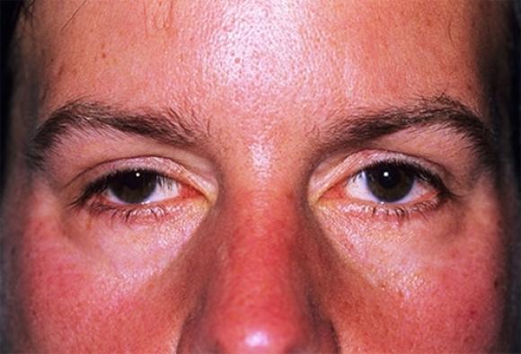 42 4 Cac Bat Thuong Nho Tren Guong Mat He Lo Cac Benh Nguy Hiem