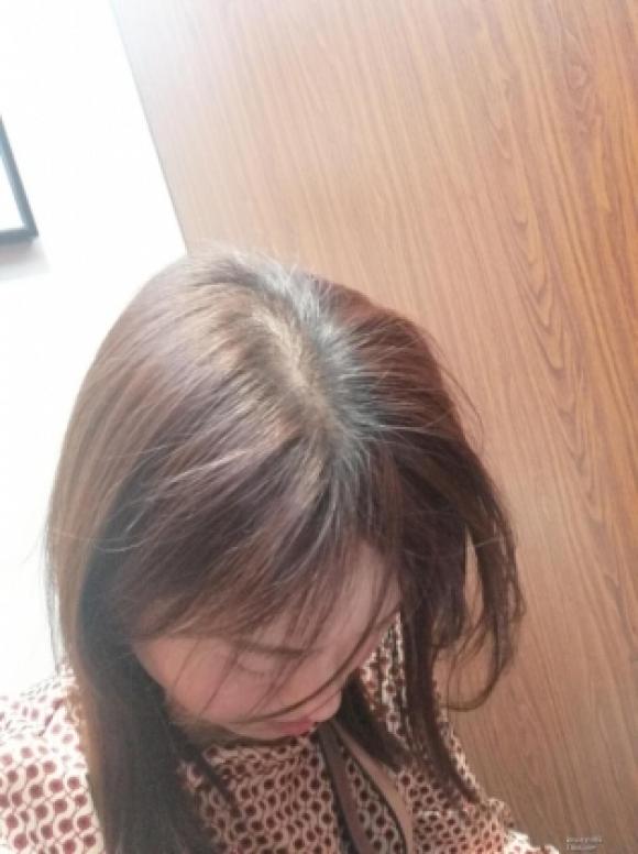 42 4 Nhuom Toc Lien Tuc 4 Lantuan Trong Thoi Gian Dai Mot Phu Nu Bi Viem Phoi Ke Va Phai Dung Thuoc Suot Doi