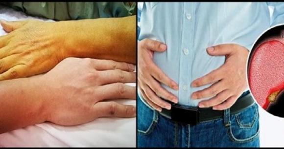 40 tuổi bị ung thư gan giai đoạn cuối, hối tiếc than: Cơ thể đã sớm kêu cứu nhưng không để ý