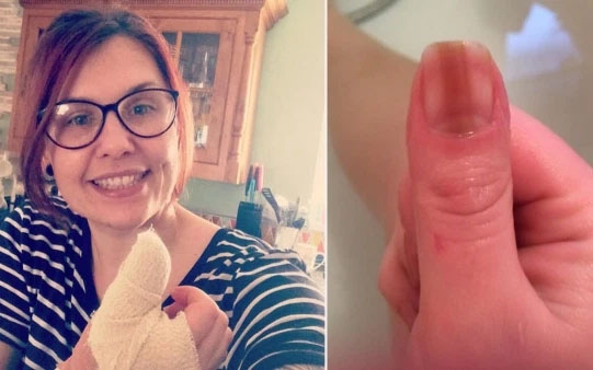 1 Son Mau Do De Che Di Mong Tay Xau Xi Nguoi Phu Nu Khong Ngo Do La Dau Hieu Ung Thu Neu Co 3 Bieu Hien Nay O Tay Can Di Kham Ngay