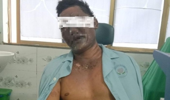 1 No Binh Gas Khi An Lau Nguoi Dan Ong Bi Bong Ca Mat