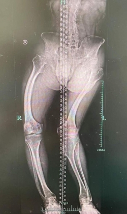 2 Chang Trai Co Xuong Song Cong Nhu Soi Mi Chi Vi Thieu Vitamin Nay