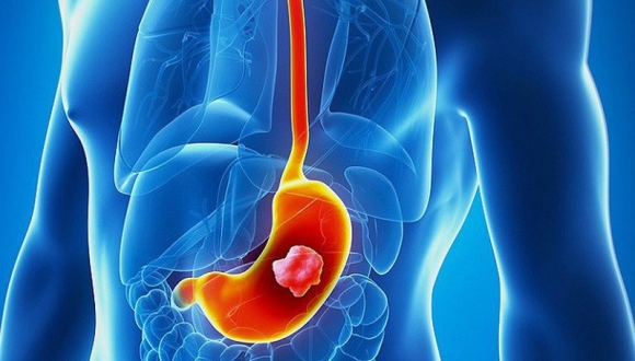 1 Cac Dau Hieu Tiem An Cua Ung Thu Da Day