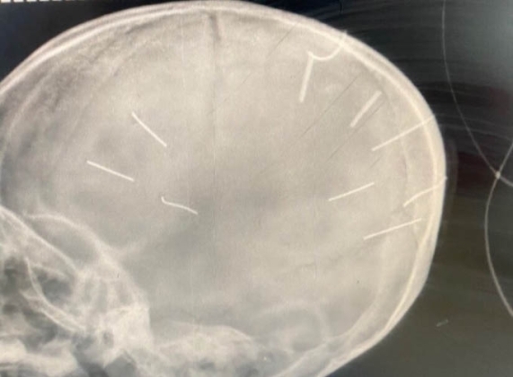 1 Ha Noi Be 3 Tuoi Hon Me X Quang Co Dinh Trong So Nghi Bi Bao Hanh