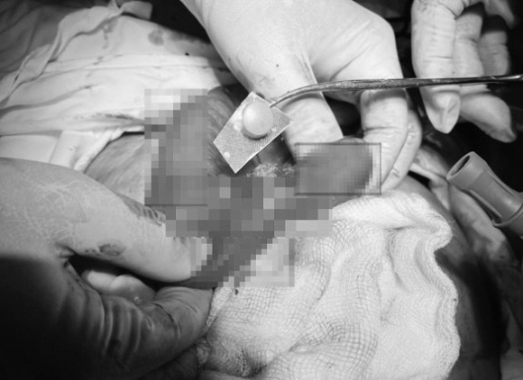 1 Uong Thuoc Quen Boc Vo Mot F0 Bi Thung Ruot Phai Nhap Vien Cap Cuu