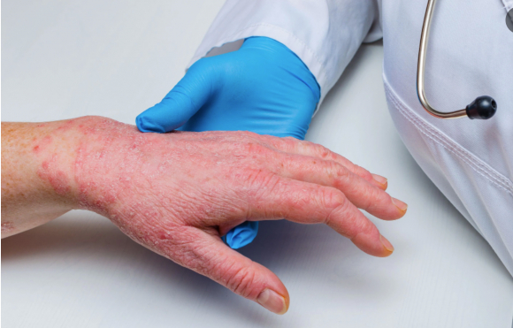 1 Them Nhieu Quoc Gia Chau Au Phat Hien Cac Ca Mac Dau Mua Khi