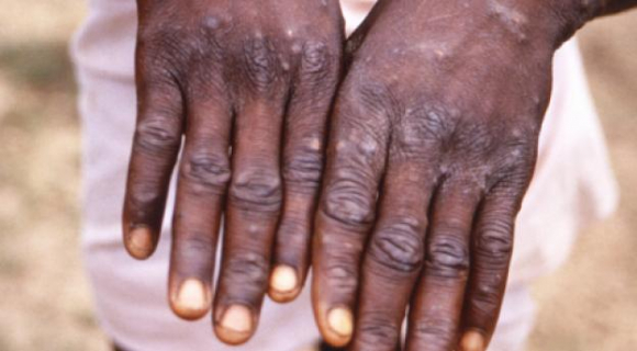 1 Benh Dau Mua Khi Lay Lan Toi 12 Quoc Gia Tren The Gioi