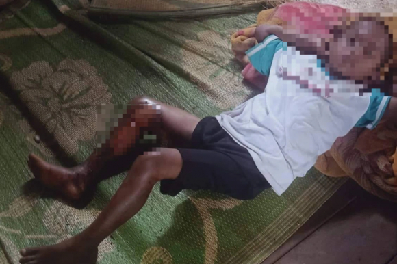 1 Chau Be 8 Tuoi Bi Tam Xang Dot Vi Khong Chiu Di An Trom