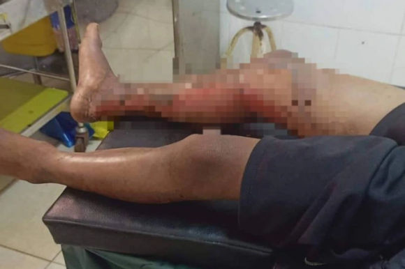 2 Chau Be 8 Tuoi Bi Tam Xang Dot Vi Khong Chiu Di An Trom