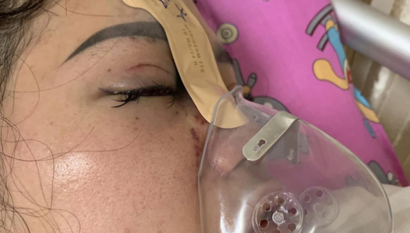 Mù mắt vì tiêm filler nâng mũi tại spa