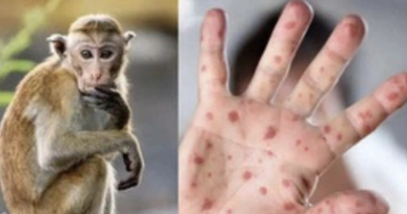 1 Ca Benh Dau Mua Khi Dau Tien Tai Ben Tre Da Tiep Xuc Voi 12 Nguoi 1 Nguoi Nghi Bi Lay