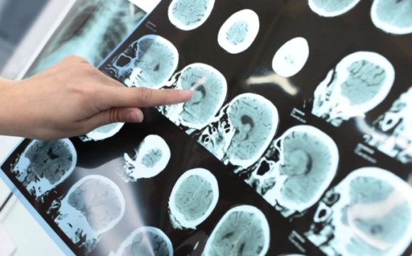 Phân biệt chóng mặt và đột quỵ