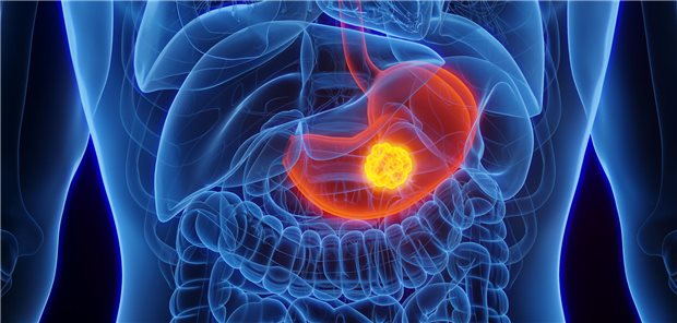 hon nua trieu ca ung thu moi nam tai duc nhung thach thuc va giai phap.jpg